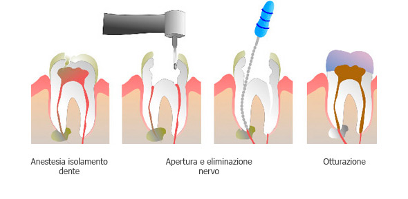 endodonzia